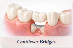 Illustration of Cantilever bridges on teeth.