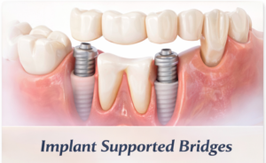 Illustration of Implant supported bridges on teeth.