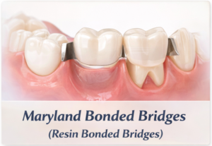 Illustration of Maryland Bonded Bridge on teeth.
