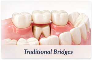Illustration of traditional bridges in teeth.