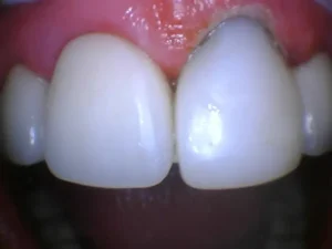 Bioclear case A- Fixed tooth snapped off at the gum line After image.