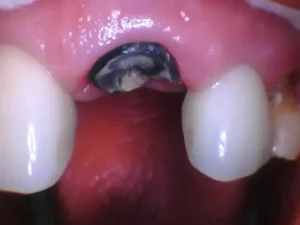 Bioclear case, snapped off tooth at the gum line, before image.