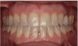 Invisalign after treatment image front teeth.