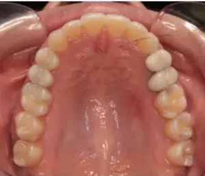 Invisalign after treatment image of upper teeth.