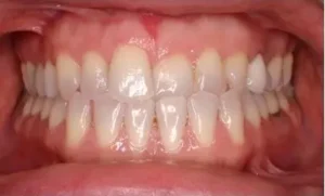 Invisalign before treatment image of front teeth