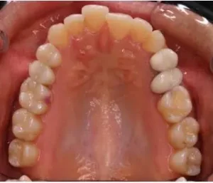 Invisalign treatment before image upper teeth