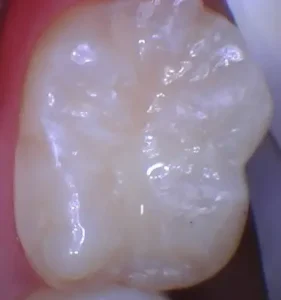 Dentist San Francisco Financial District composite, after image of single tooth