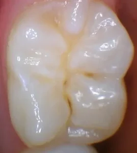 Dentist San Francisco Financial District composite, before image of single tooth