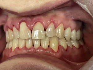 Deep cleaning after picture by Digital Dental Practice Dentist in San Francisco Financial District