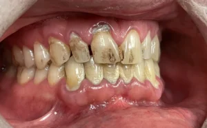 Deep cleaning Before picture.