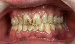 Deep cleaning before picture Dentist Financial District