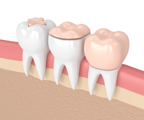 Inlays-and-Onlays