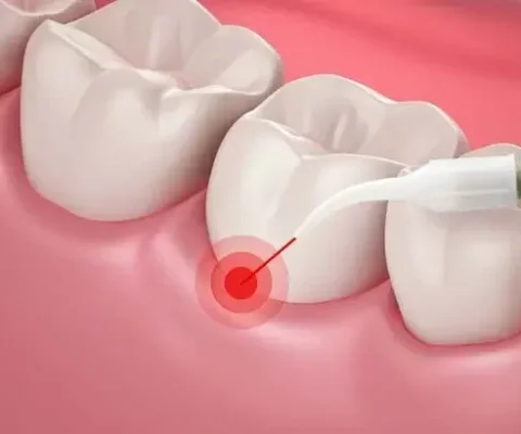 periodontal-laser-therapy-gum-disease